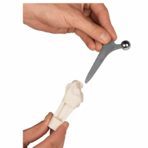 PROTHESE DE LA HANCHE DE ZIMMER