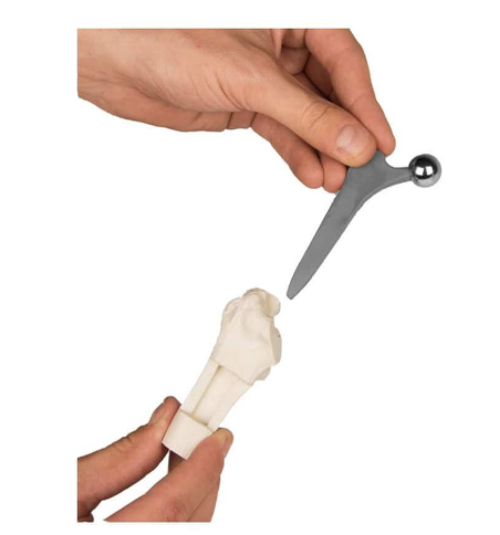 PROTHESE DE LA HANCHE DE ZIMMER