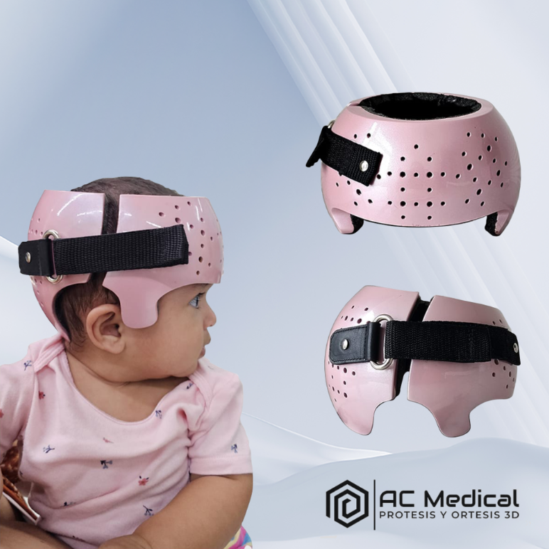 CASQUE ORTHESE ORTHOPEDIQUE DE REMODELAGE CRANIEN – Image 3