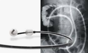 DOUBLE BALLON ENDOSCOPIQUE – Image 3
